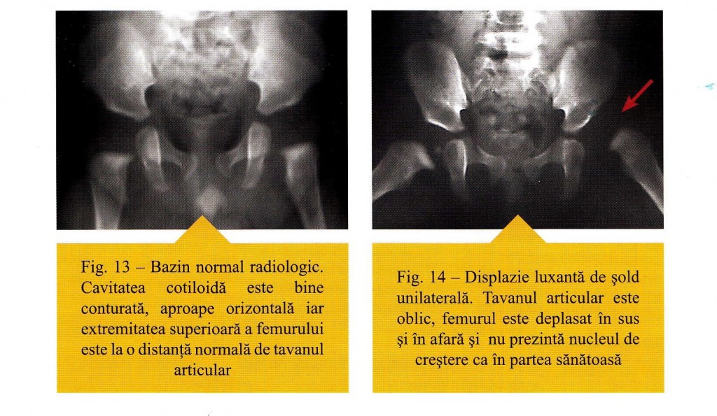 radiografie bazin normala